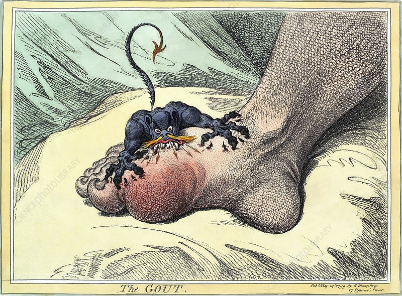 Gout_engr [https://www.sciencephoto.com/media/573029/view]